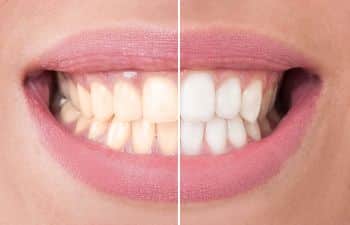 teeth whitening before/after